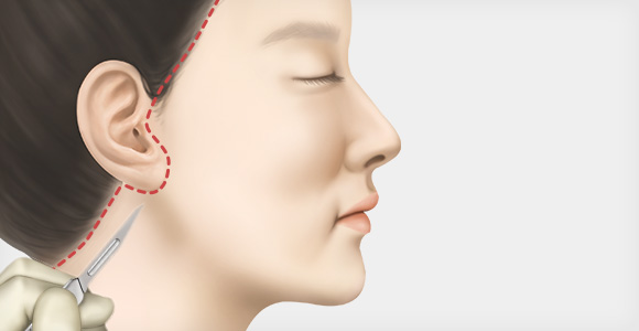 절개 진행