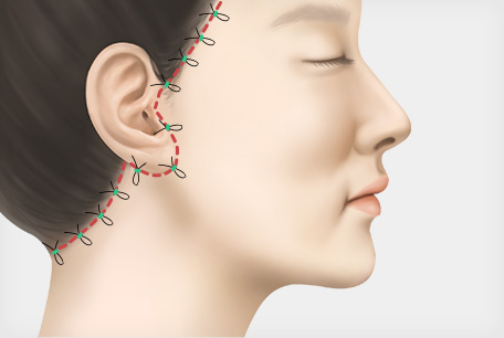 수술 2중 봉합 후 마무리