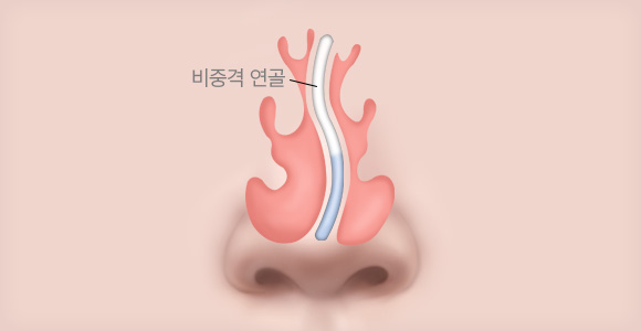 비중격만곡증 수술 전