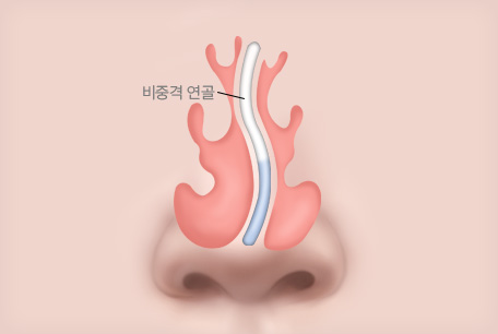 비중격만곡증 수술 전