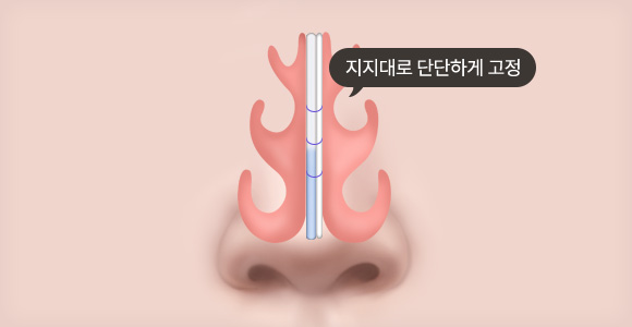 비중격을 튼튼하게 보강