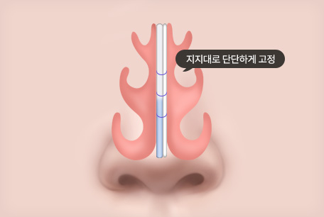 비중격을 튼튼하게 보강