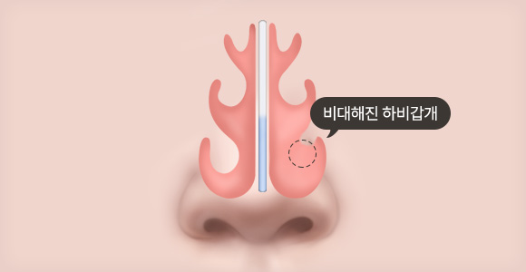 하비갑개 비대증 수술 전