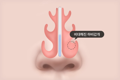하비갑개 비대증 수술 전