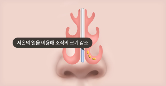 고주파 비염 수술