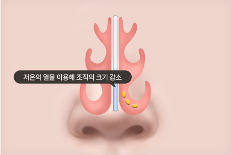 고주파 비염 수술