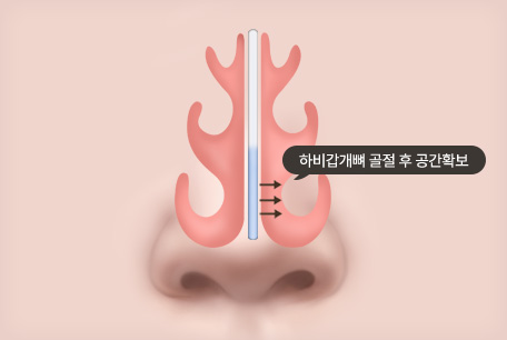 외향 골절술