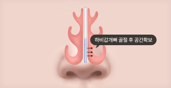 외향 골절술