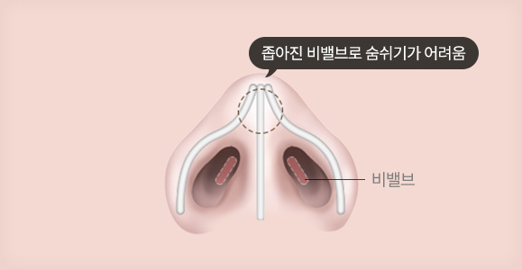 비밸브 협착증 수술 전