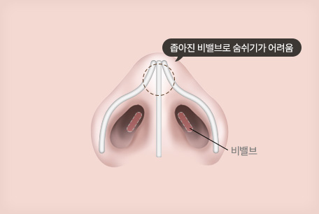 비밸브 협착증 수술 전