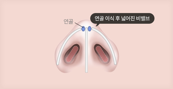 펼침 이식 (쐐기 이식)