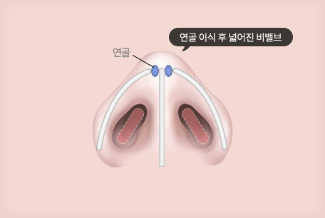 펼침 이식 (쐐기 이식)