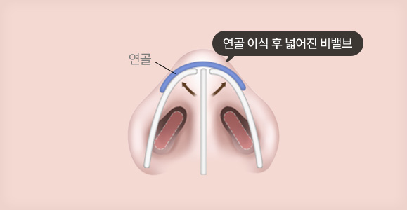 나비 이식