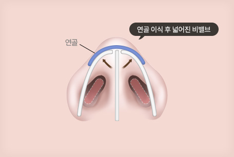 나비 이식