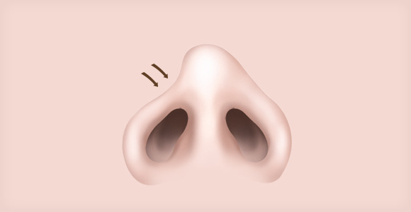 휘어진 코 / 콧구멍 비대칭이 심한 코