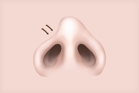휘어진 코 / 콧구멍 비대칭이 심한 코