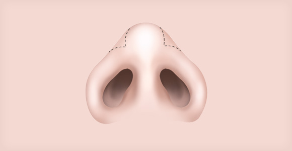 코끝이 찝혀보이는 코