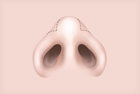 코끝이 찝혀보이는 코