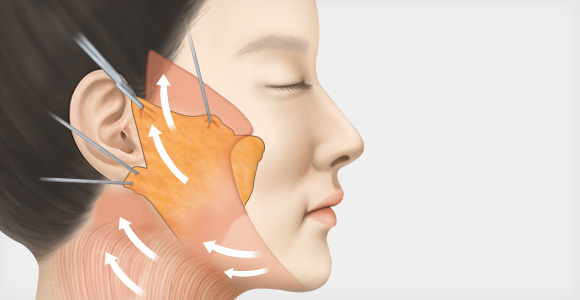 SMAS층과 피하층을 한번에 당겨 견고하게 고정