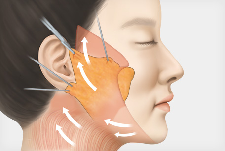 SMAS층과 피하층을 한번에 당겨 견고하게 고정