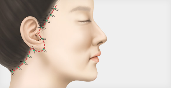 수술 2중 봉합 후 마무리