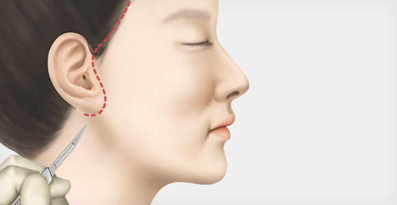 절개 진행