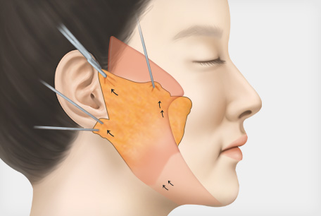 근막층을 견고하게 고정