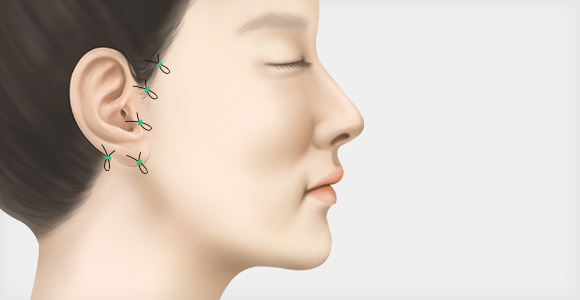 봉합 및 사후 관리