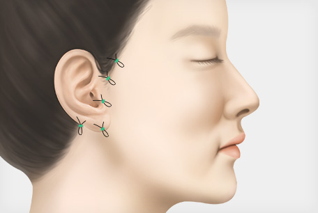 봉합 및 사후 관리