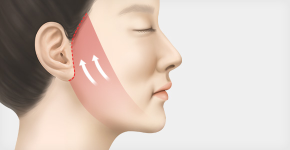 안면거상