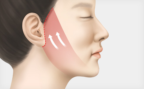 안면거상