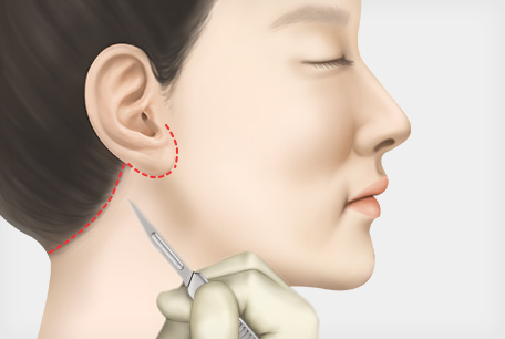 라인에 따라절개