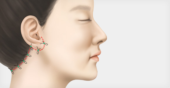 2중 봉합 후 마무리