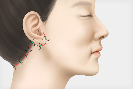 2중 봉합 후 마무리