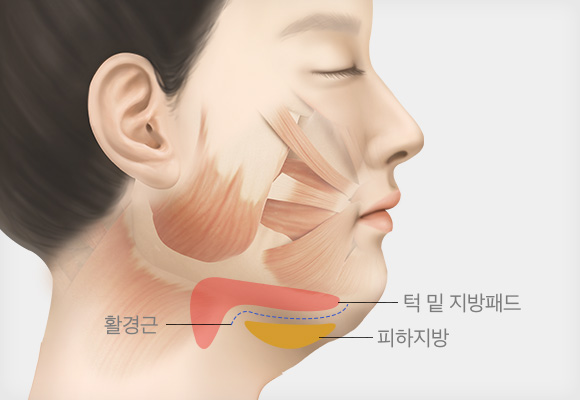 활경근 및 지방 패드