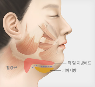 활경근 및 지방 패드