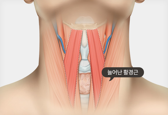 SMAS층과 피하층을 한번에 당겨 견고하게 고정