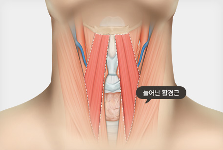 SMAS층과 피하층을 한번에 당겨 견고하게 고정