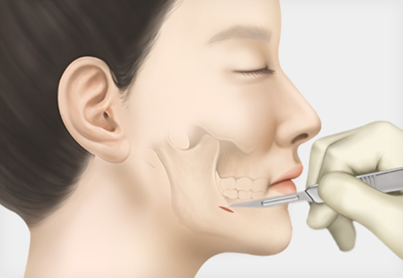 입 안 1cm절개