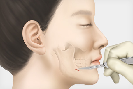 입 안 1cm절개
