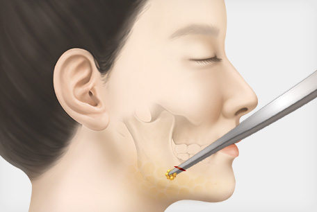 심부볼 지방 제거