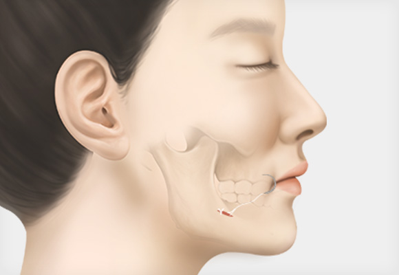 봉합