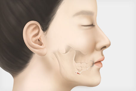 봉합