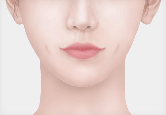 긴 보조개