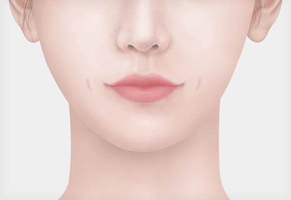 수술 볼 가운데 보조개